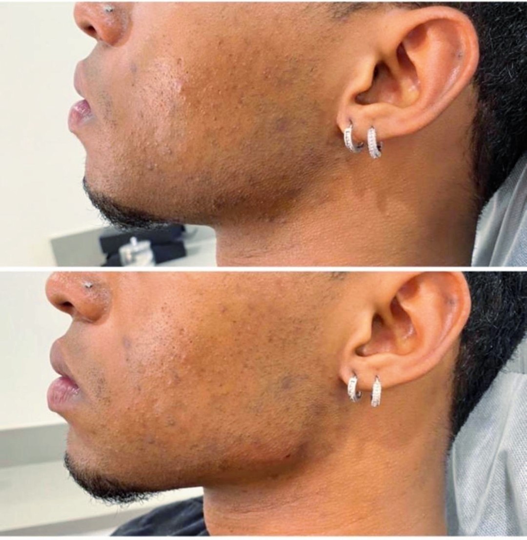 Acne scars