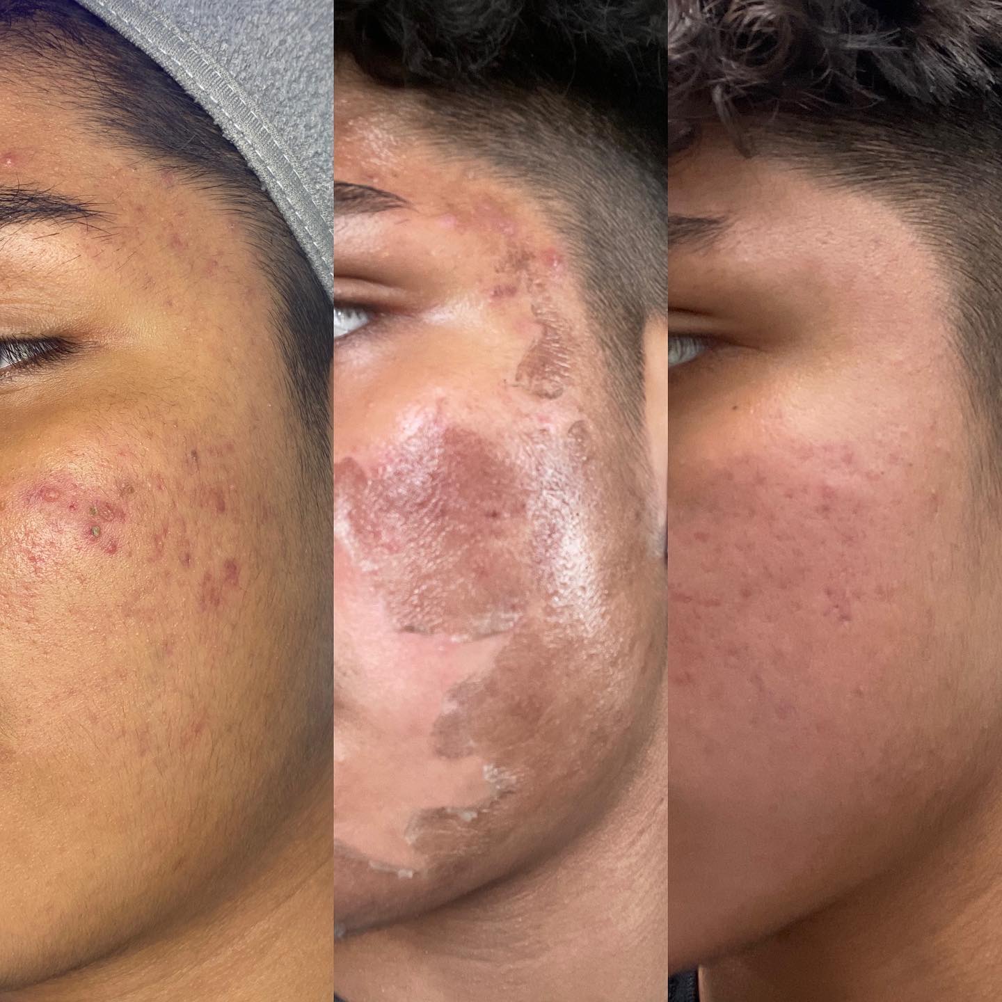 Active acne