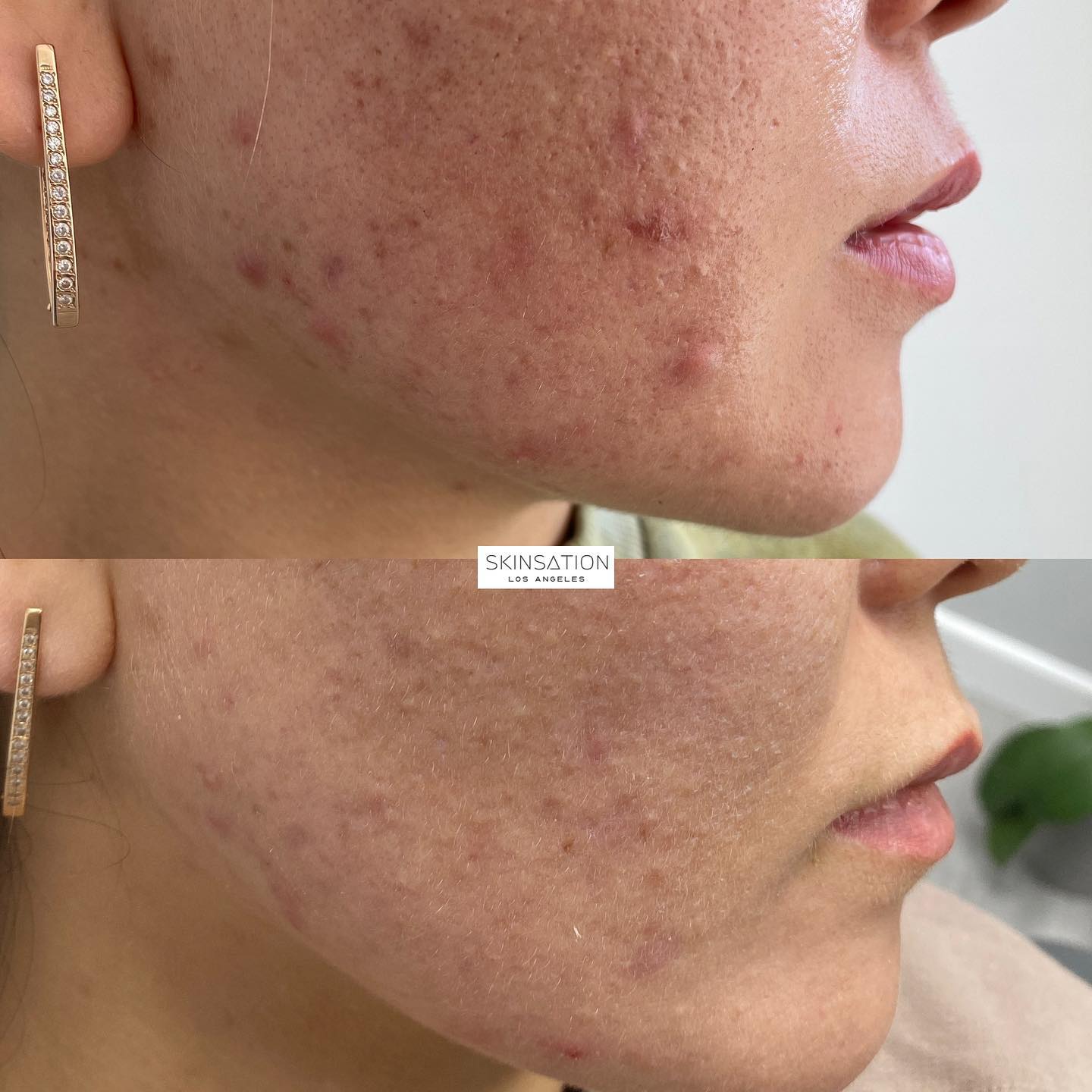 One treatment