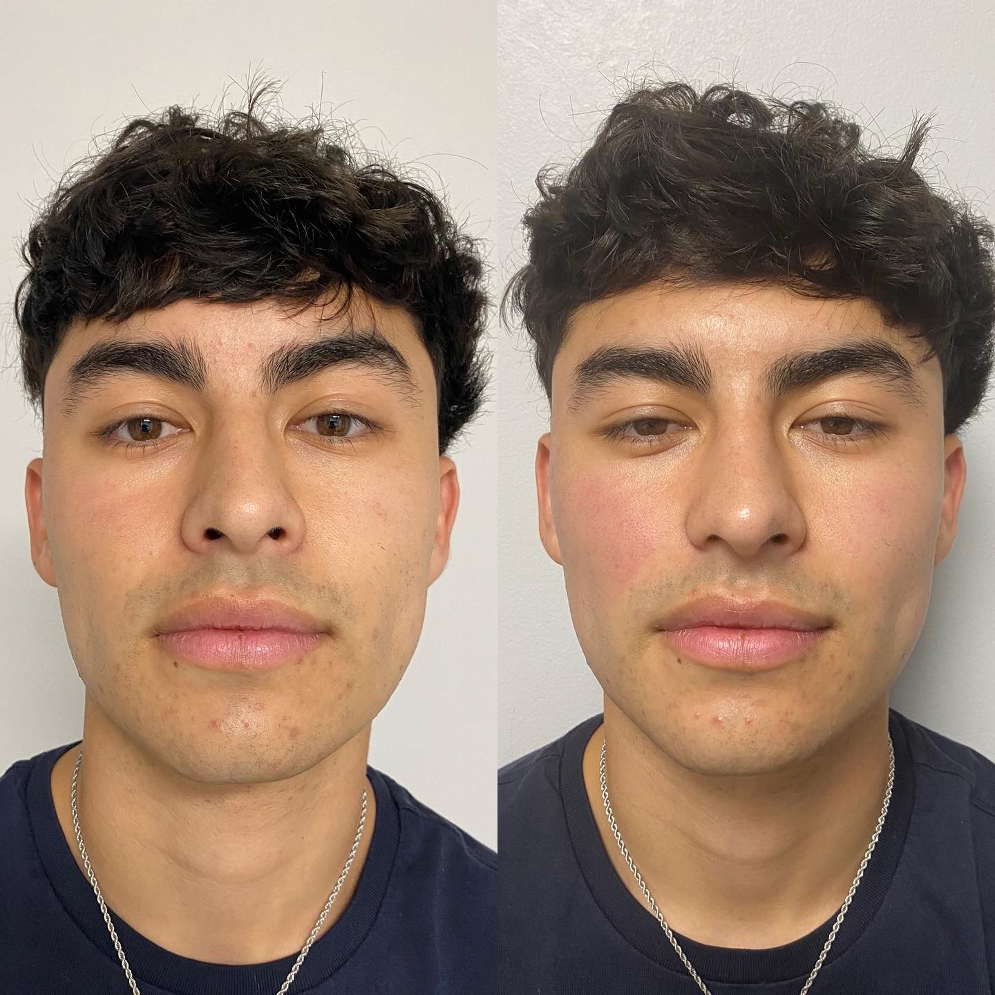 Looking full and tired? InMode Forma facial is a safe, effective way to tighten and plump your skin, without the use of needl