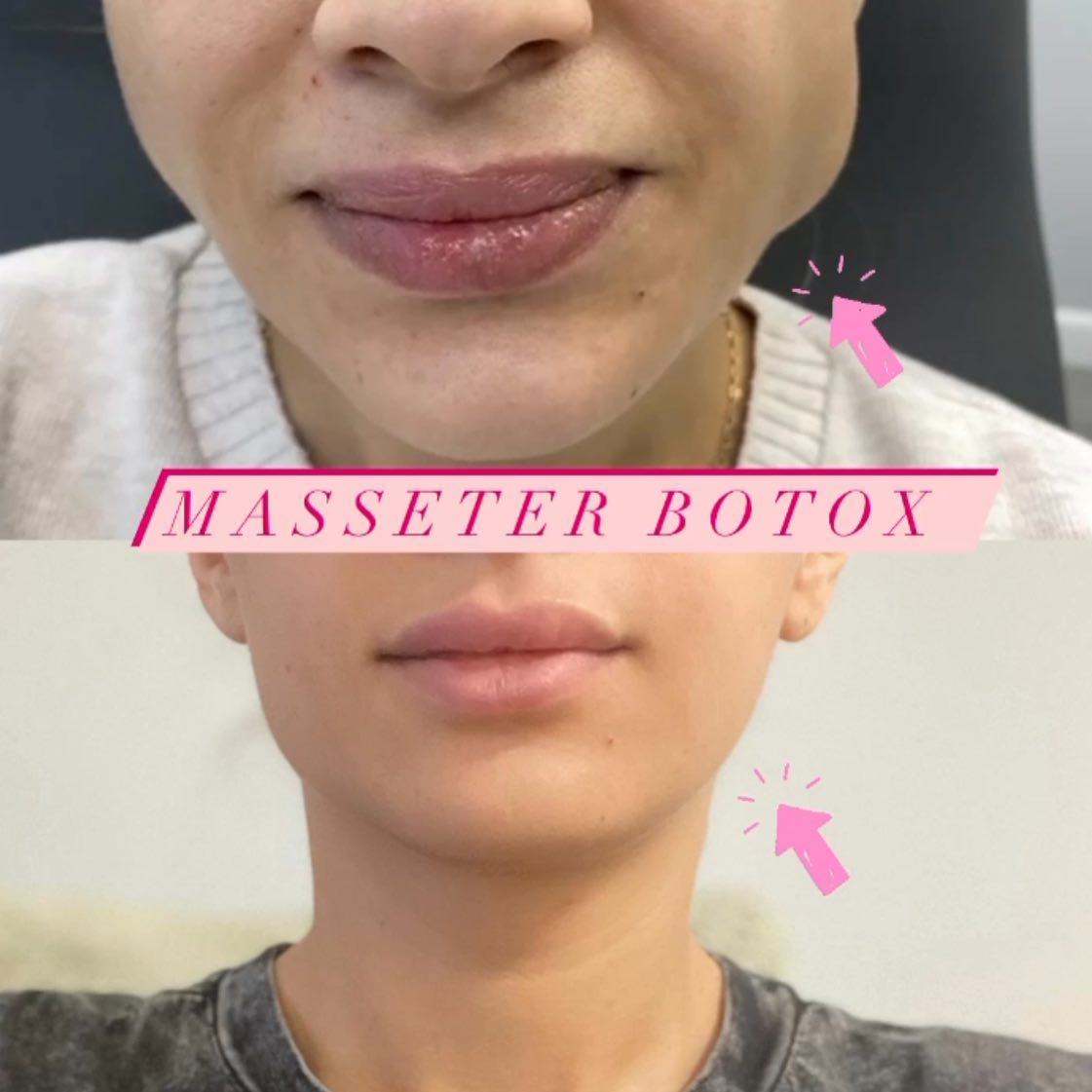 Masseter