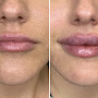 Russian lip