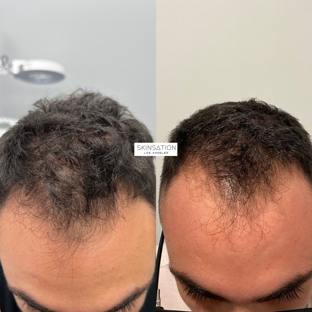 Hair restoration