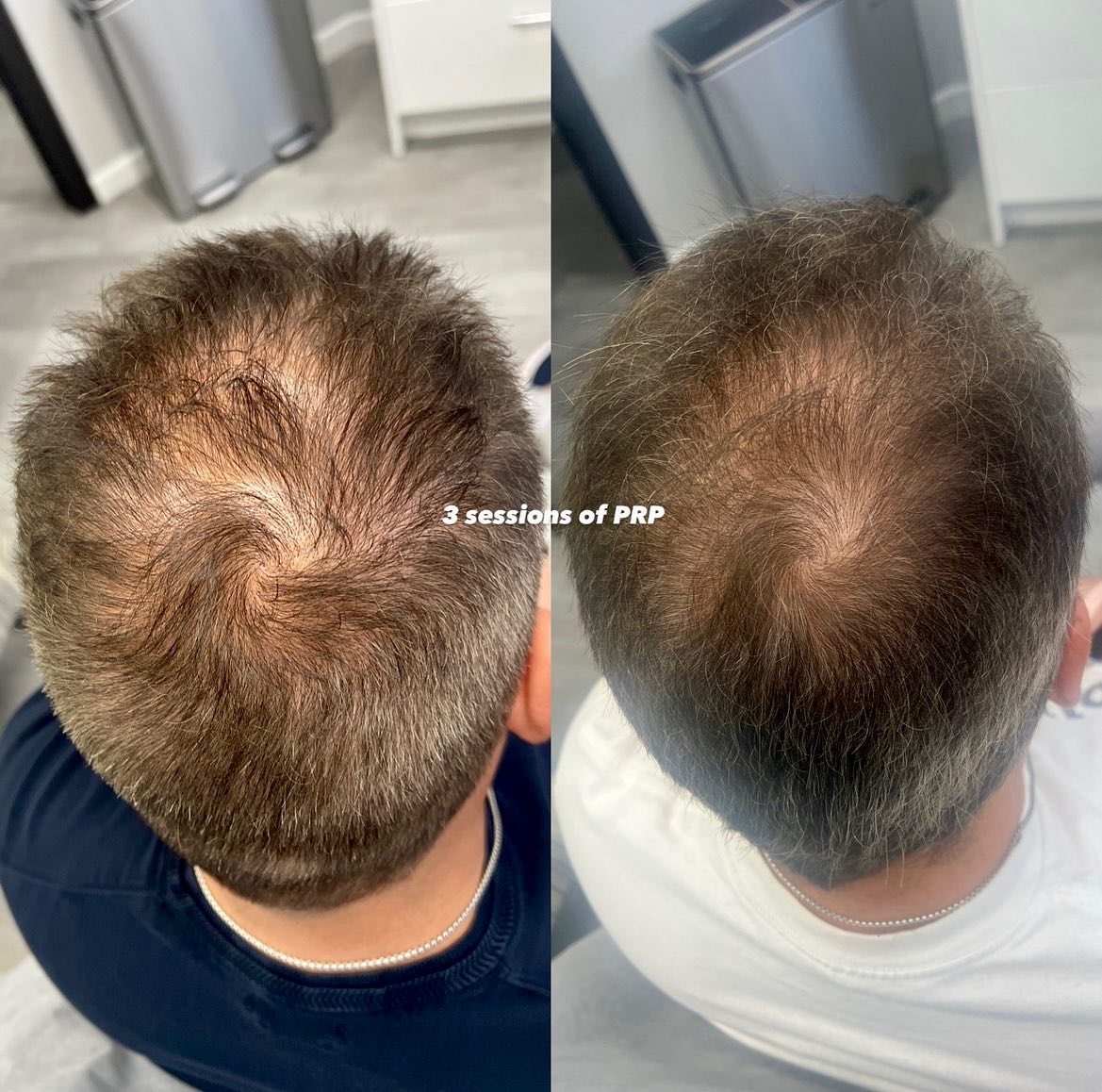 Hair restoration