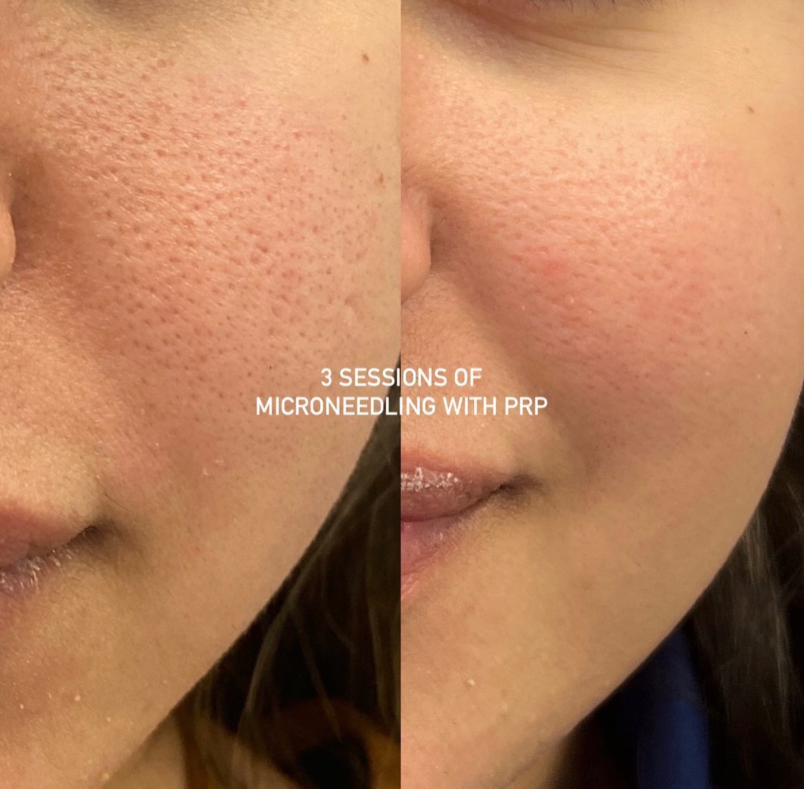 Vampire facial