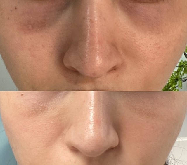 Under-eye
