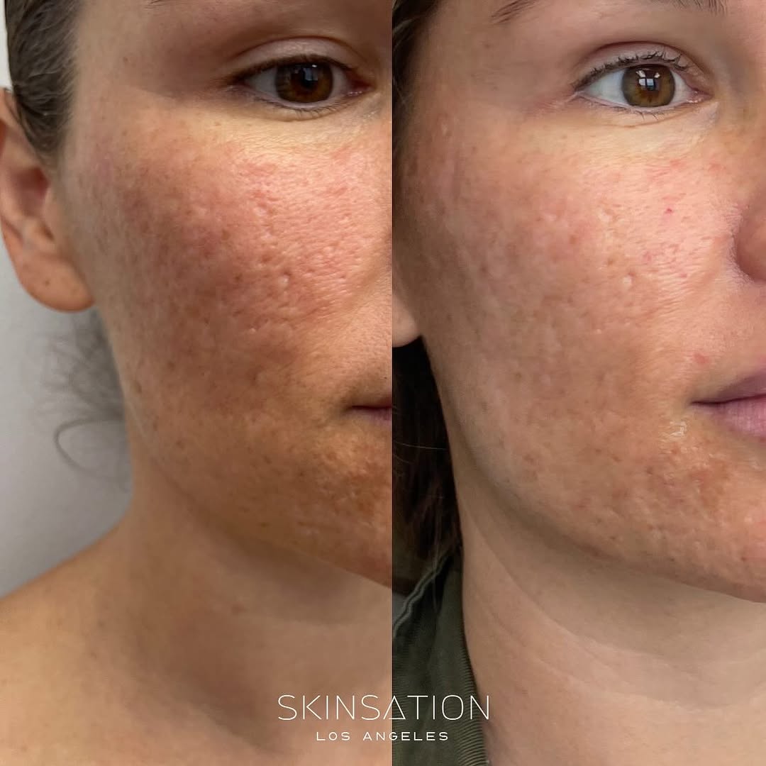 Skinsation LA Beverly Hills patient — acne-scarring treatment with Morpheus8 and radiofrequency microneedling
