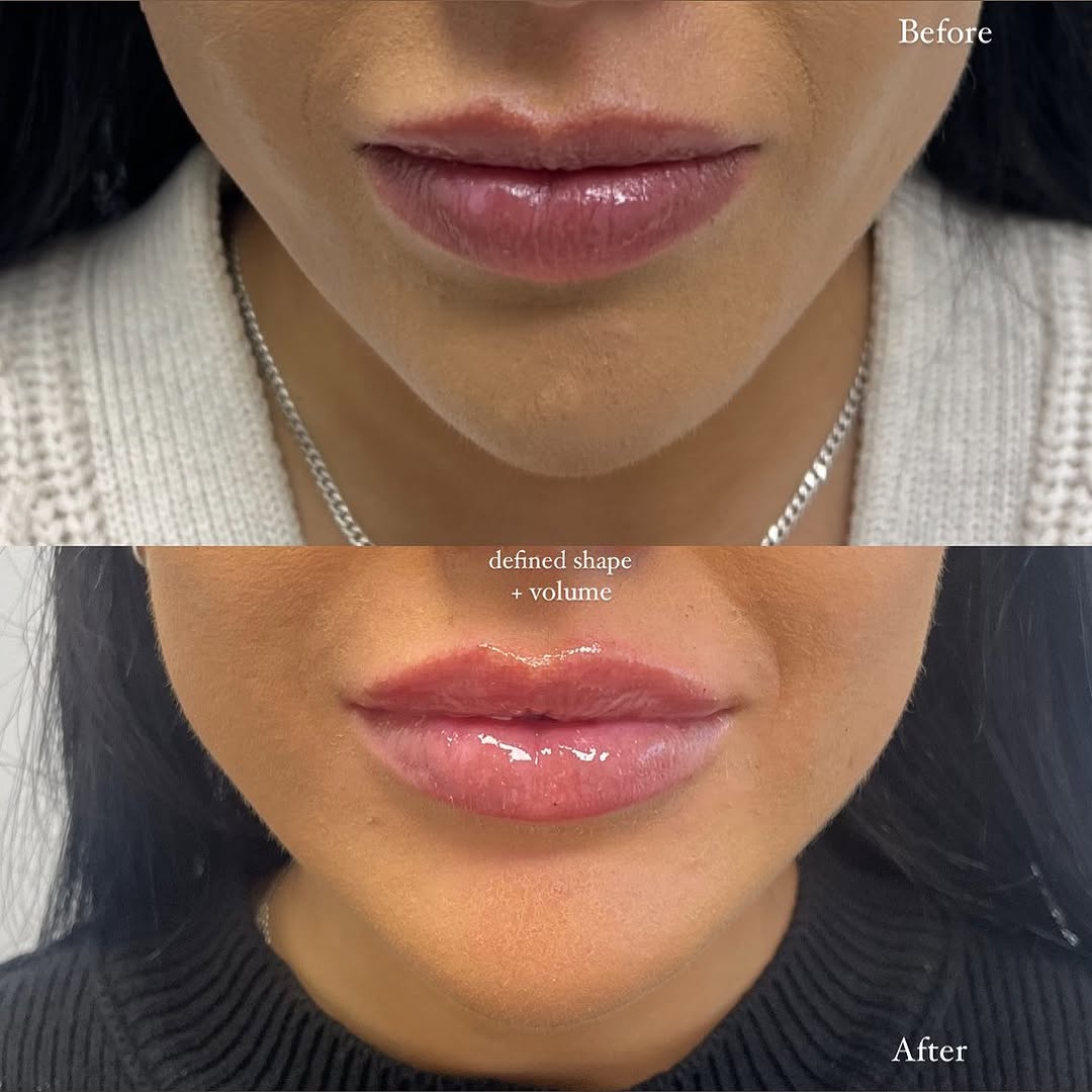 Defined shape + borders More volume + plumpness . . #lips #lipfiller #lipinjections #hafillers #kylielips #lipflip #skincare