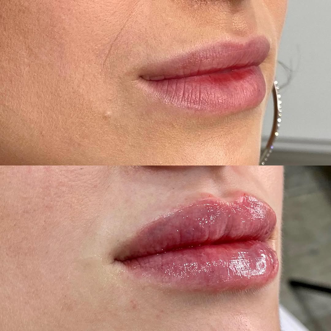 Lip flip + filler combo