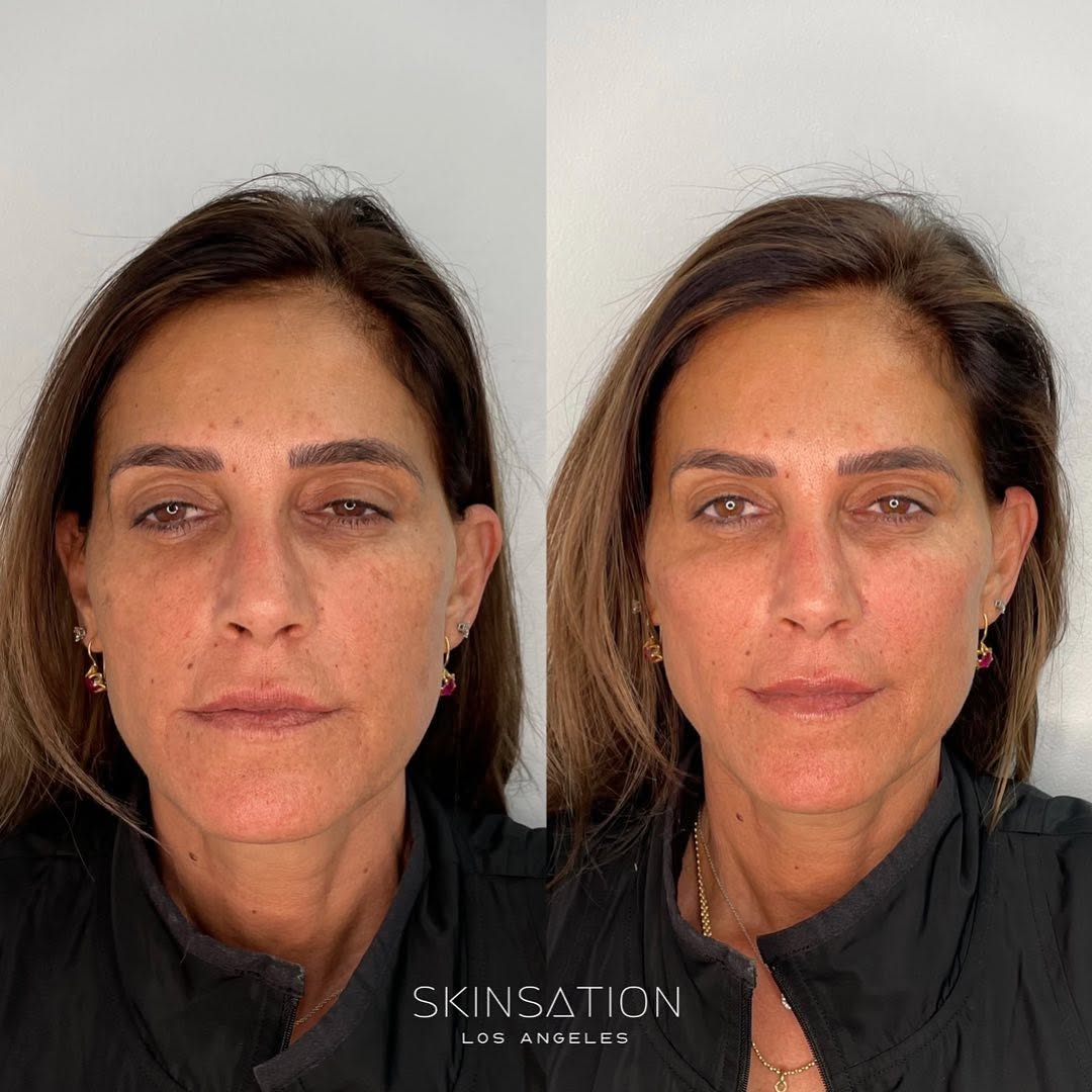 Cheek lift