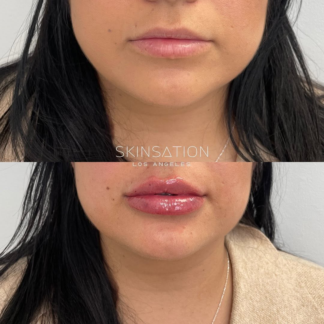 Who doesn’t love a fresh pout? . . . 💋 Filler Promo:💲500 Ends 6/30 To prepay: call or txt 213.493.9520 . . . #filler…