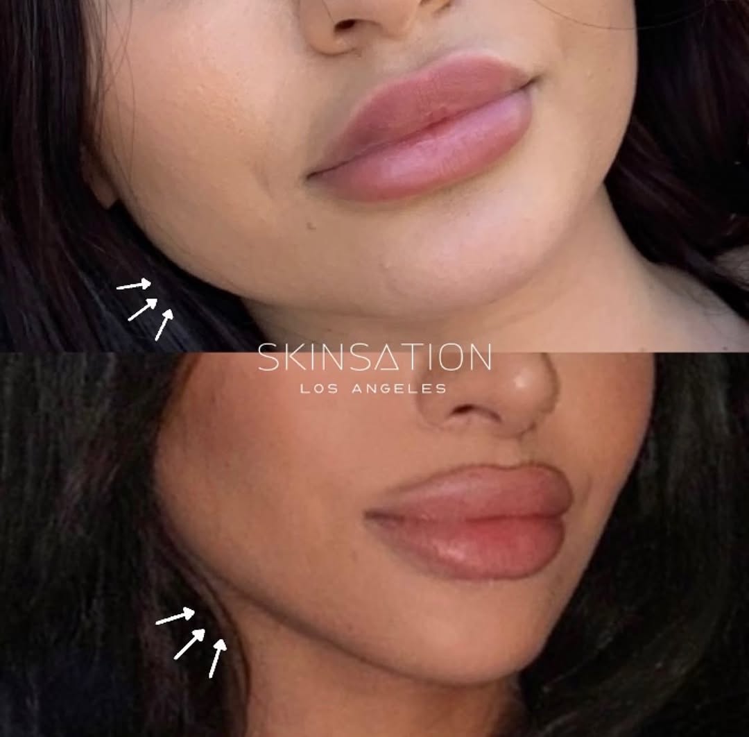 Jaw slimming