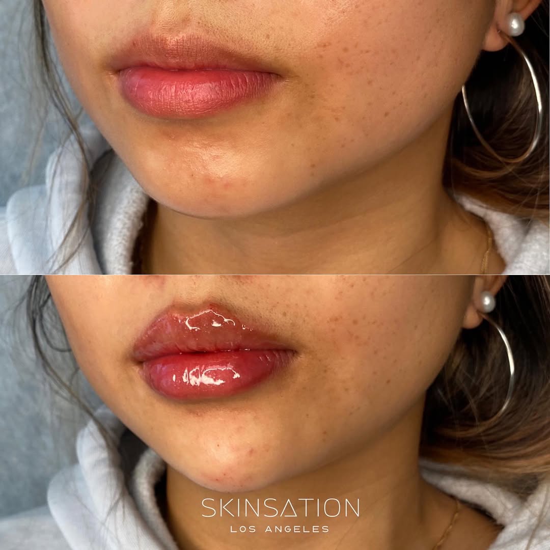 Lip fillers💋 which filler do you prefer for your lips? . . #lips #lipfiller #losangelesfillers #russianlips #skin…