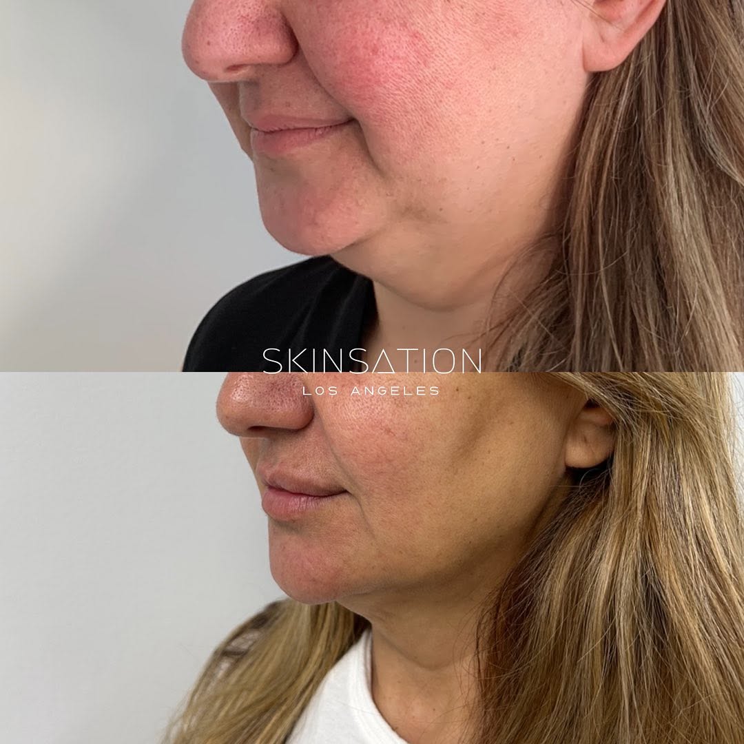 Fat reduction + tightening