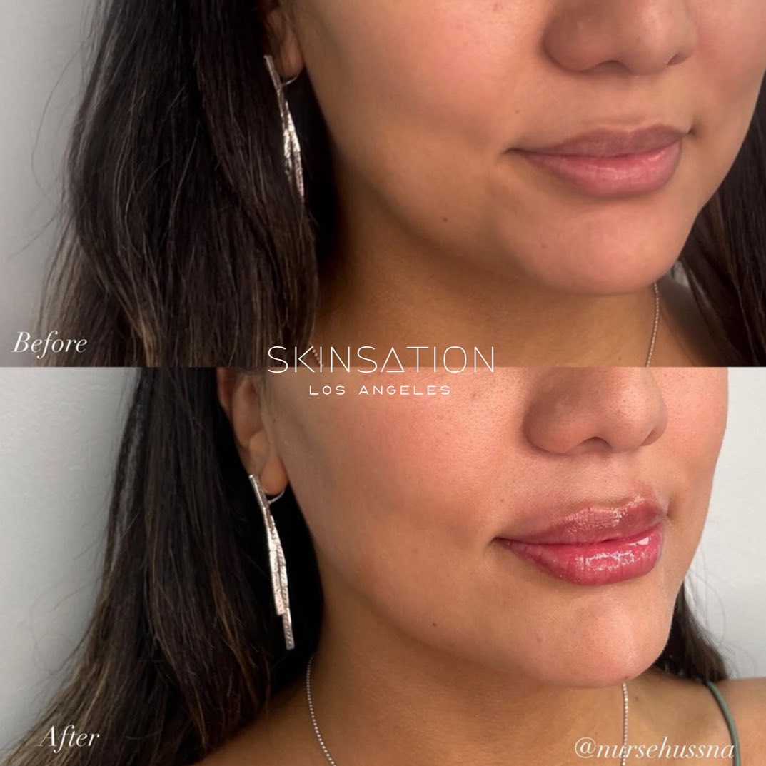 Lip + Chin Enhancement by @nursehussna ✅facial balance ✅lip shape + volume ✅lower face contour . . #facial #skin #lips #lipfi