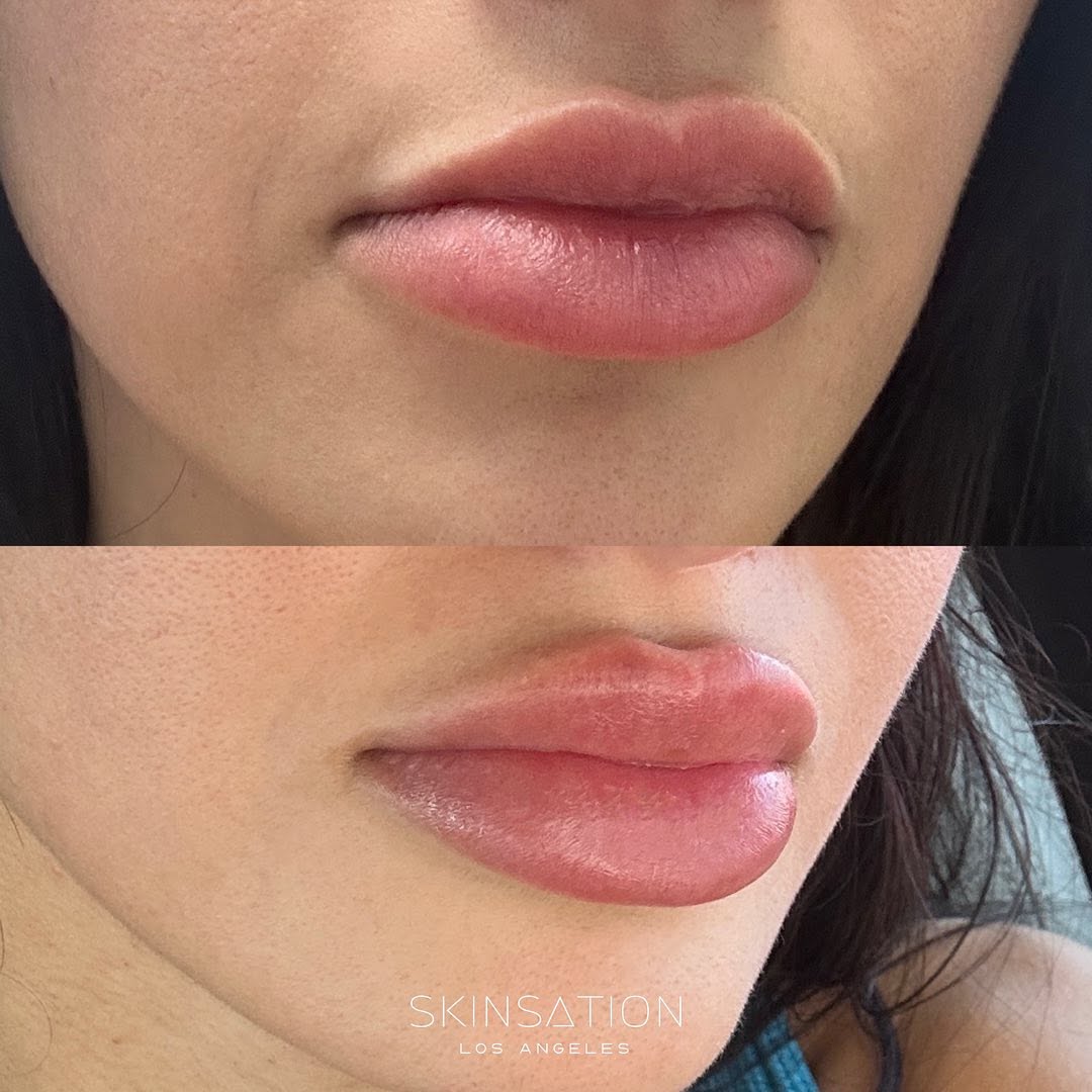 Lip dissolve + refill