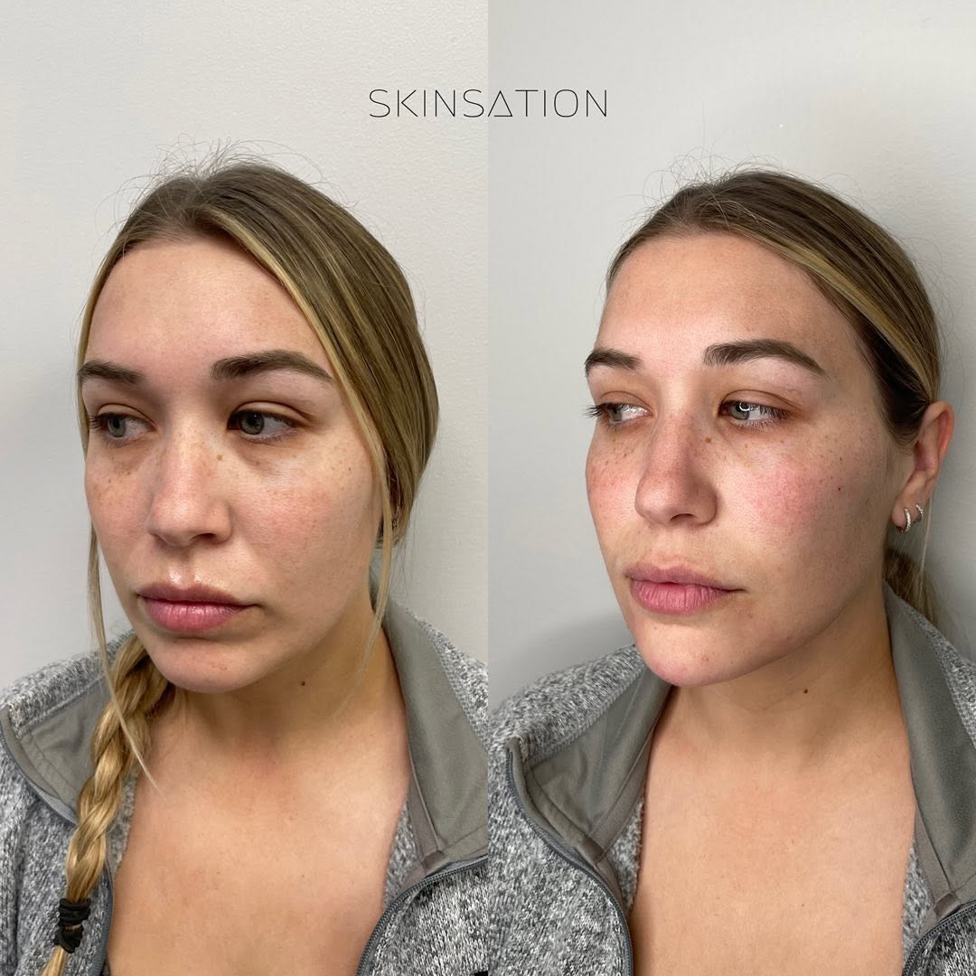 Full facial contour