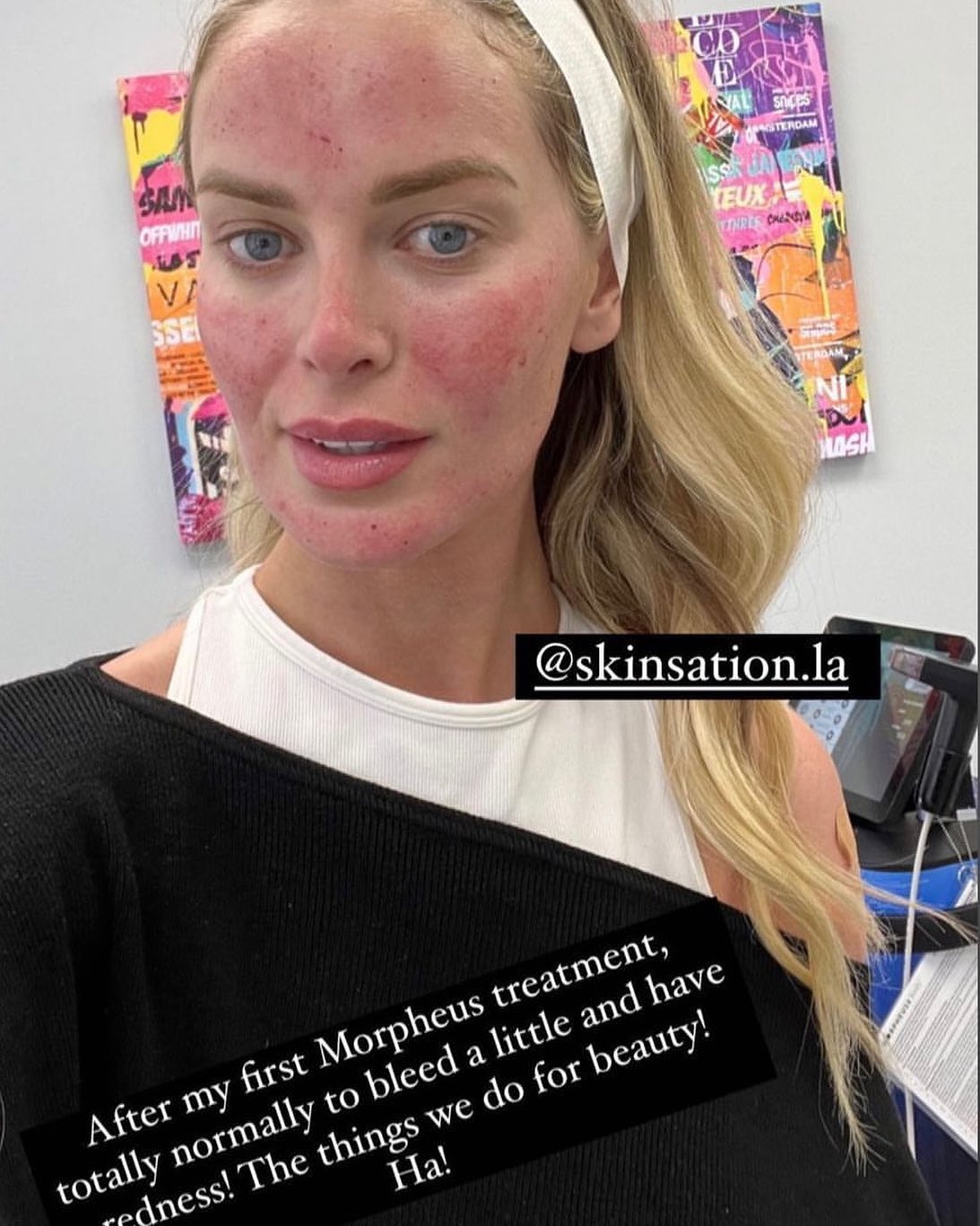 @iamkatyjohnson - Skinsation LA client
