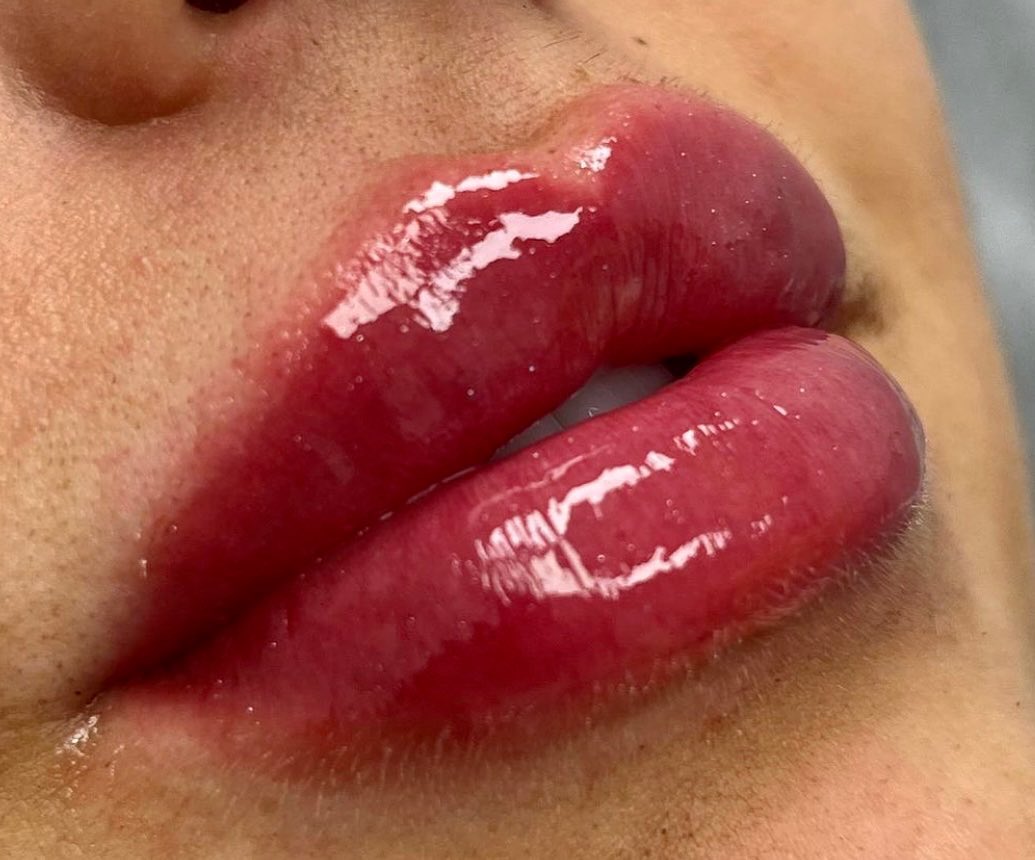 Juicy lips using @juvederm xc💋 Our client has been slowly building up her lips for more volume and to enhance her natural…