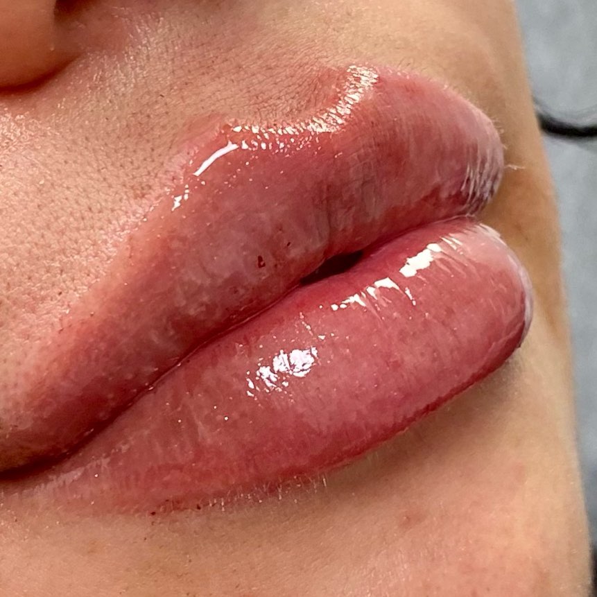 Lip fillers can enhance your shape and give volume to your lips. ⭐️For my lip virgins, it’s important to remember that gettin