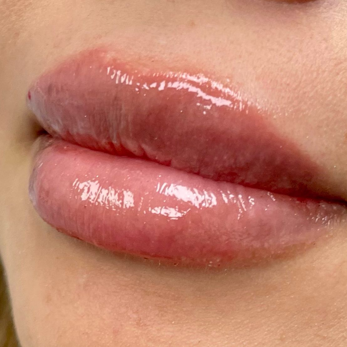 ⭐️Most lip enhancement is done through Hyaluronic acid-based fillers. These include fillers from Juvederm family such as Juvé
