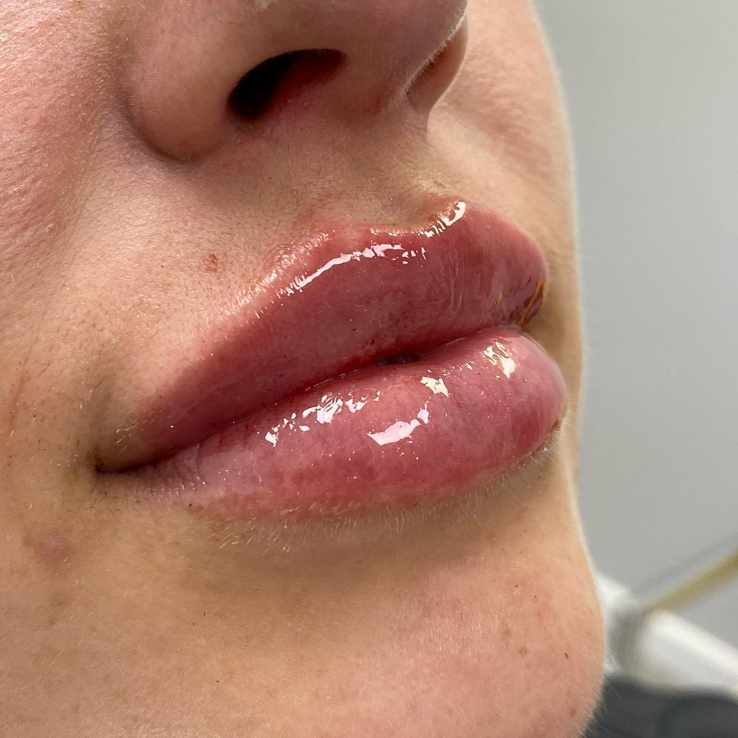 Who else loves that initial plumpness the first 2 weeks of their lip filler?😍 we used a full syringe of Restylane here to…