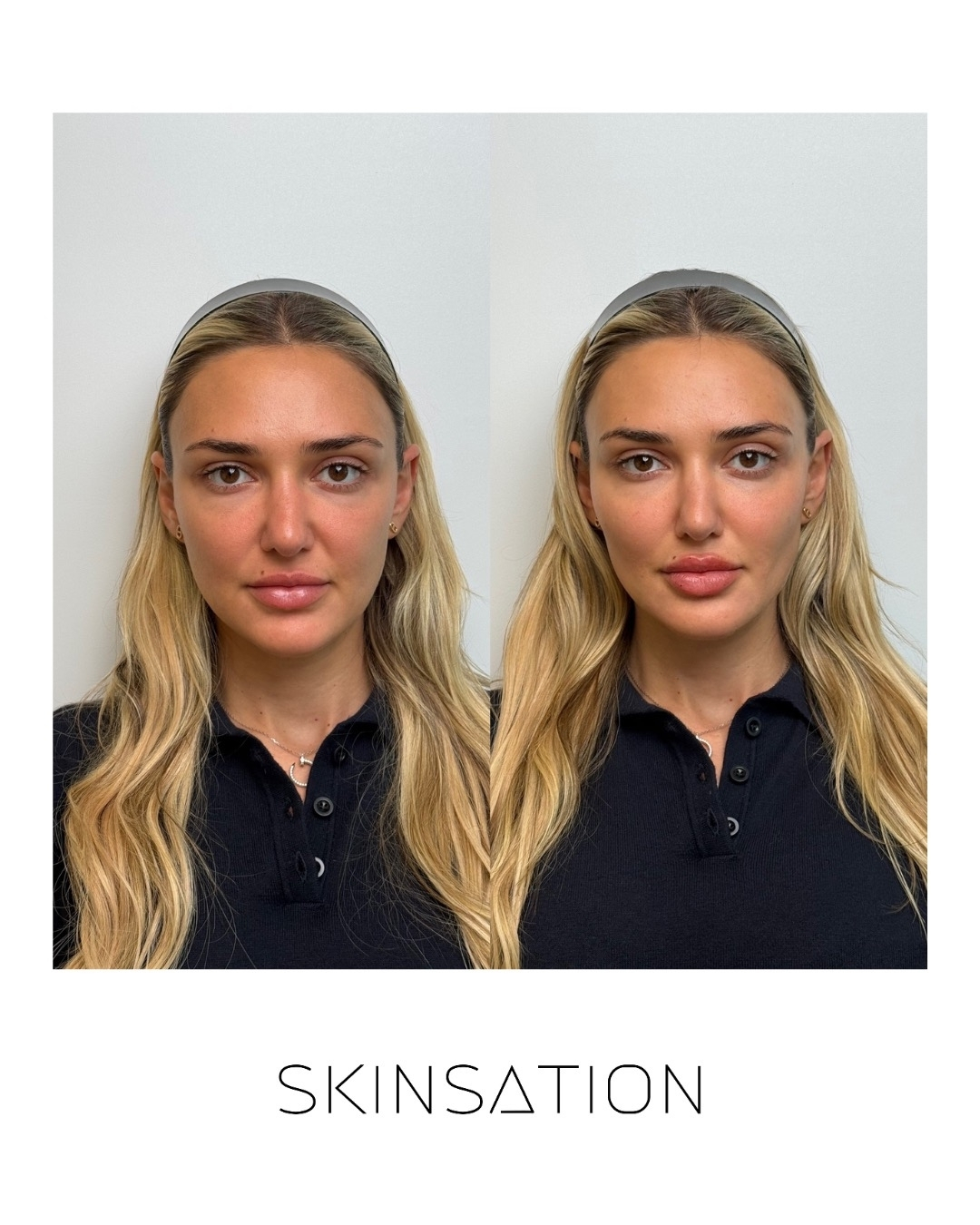 Injectable before and after result 1