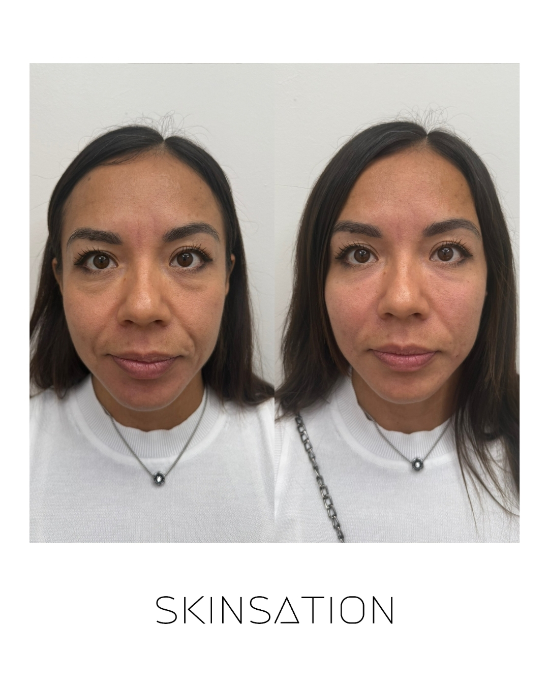 Injectable before and after result 2