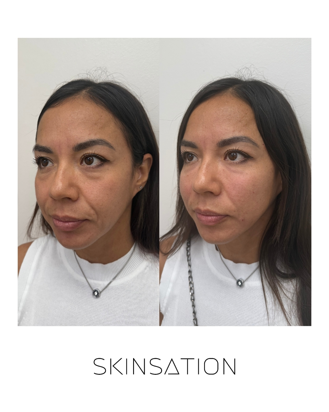 Injectable before and after result 3