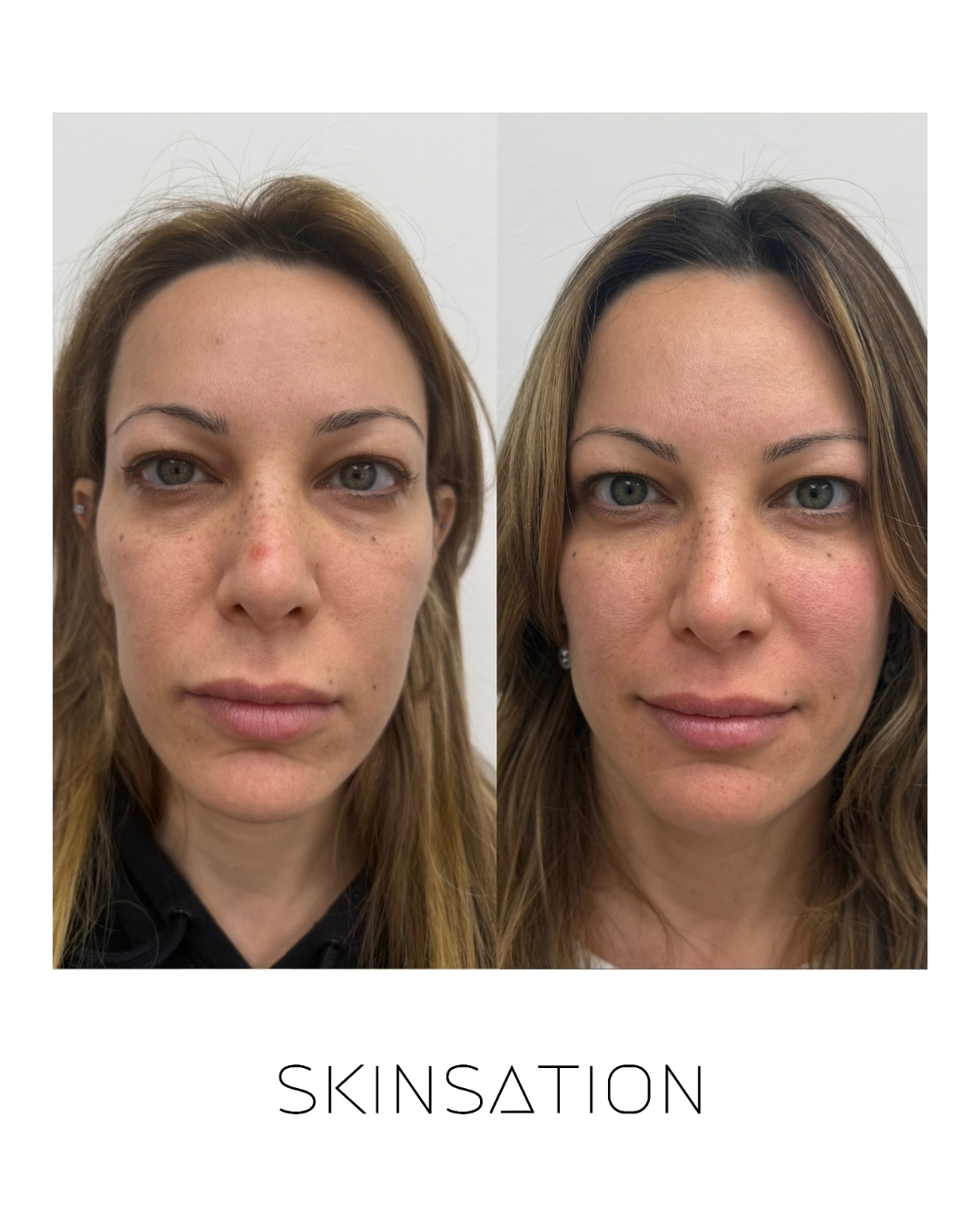 Injectable before and after result 4