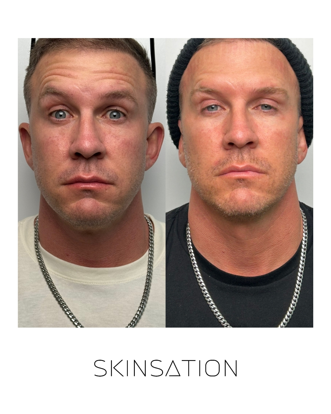 Injectable before and after result 5