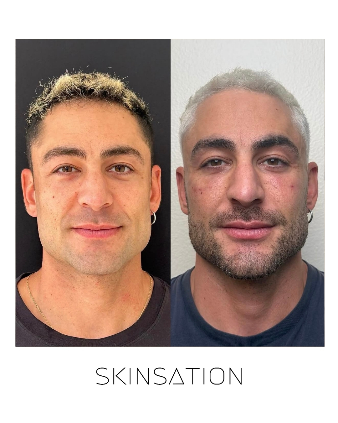 Injectable before and after result 6