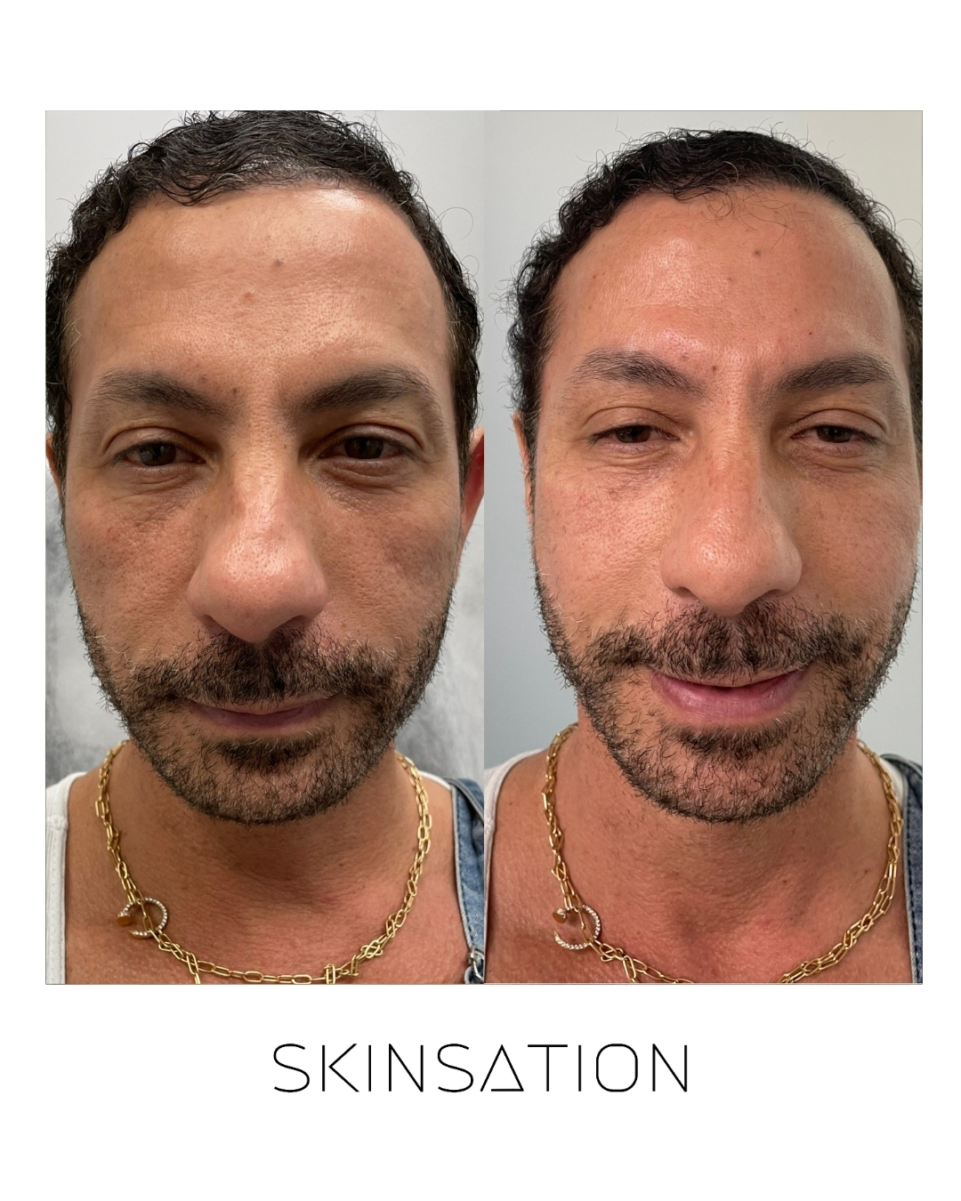 Injectable before and after result 7