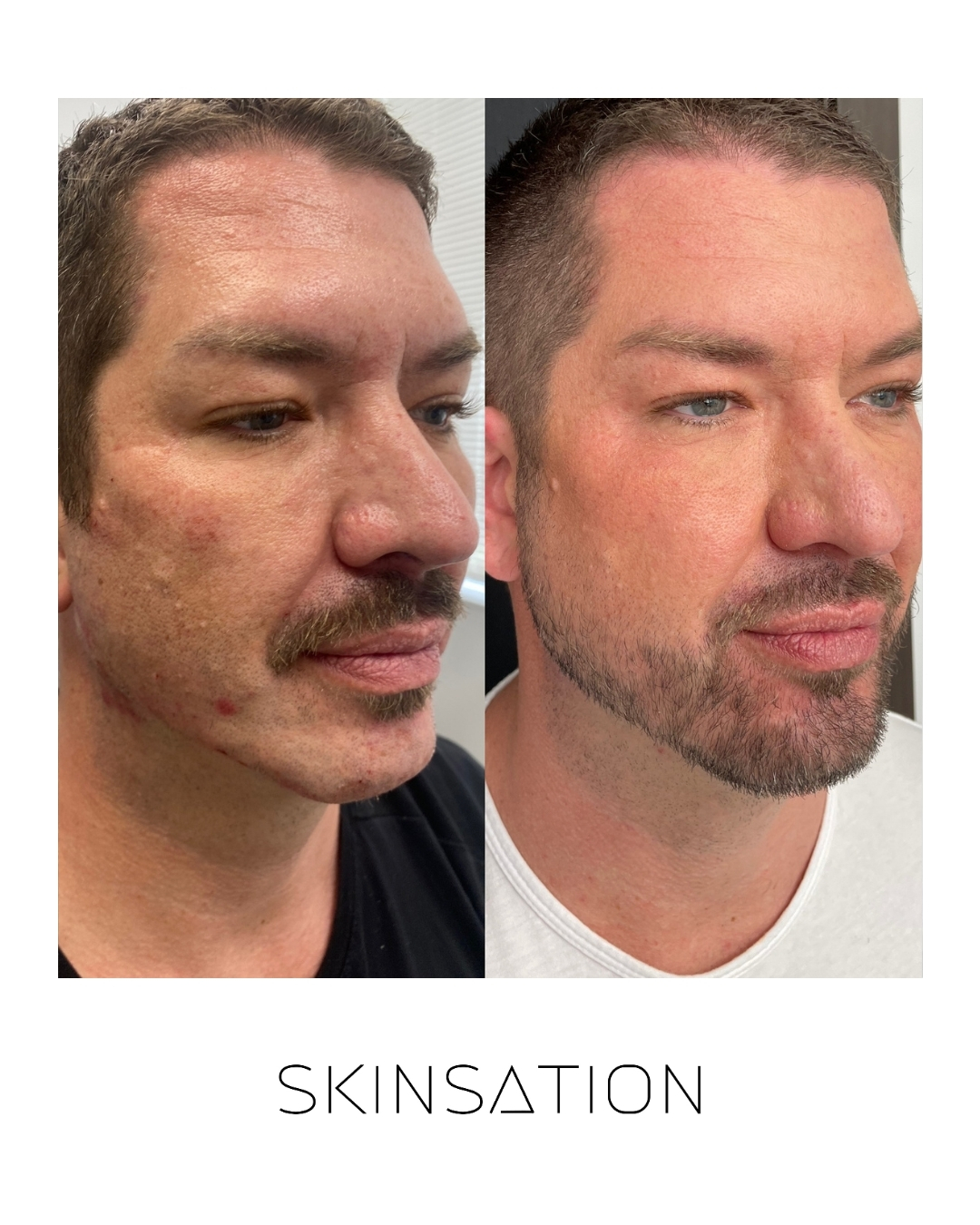 Injectable before and after result 8