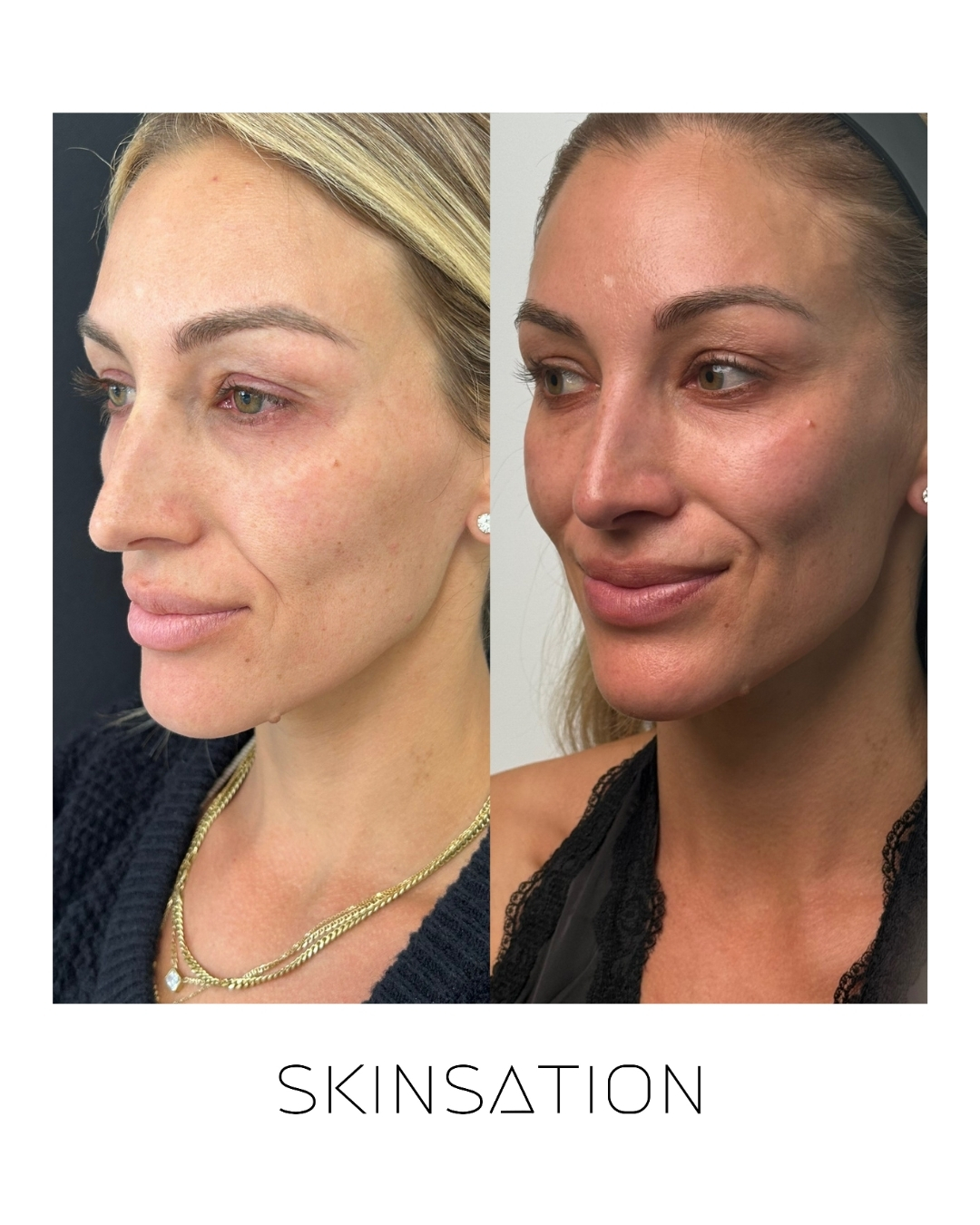 Injectable before and after result 9