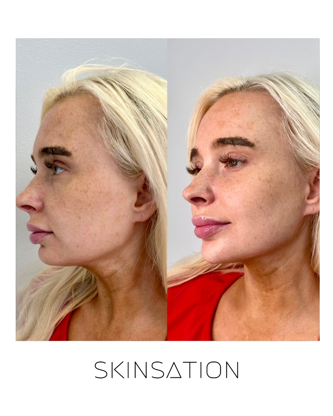 Injectable before and after result 10