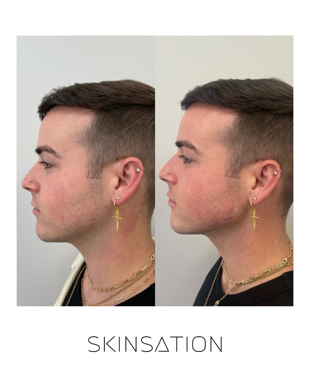 Injectable before and after result 11