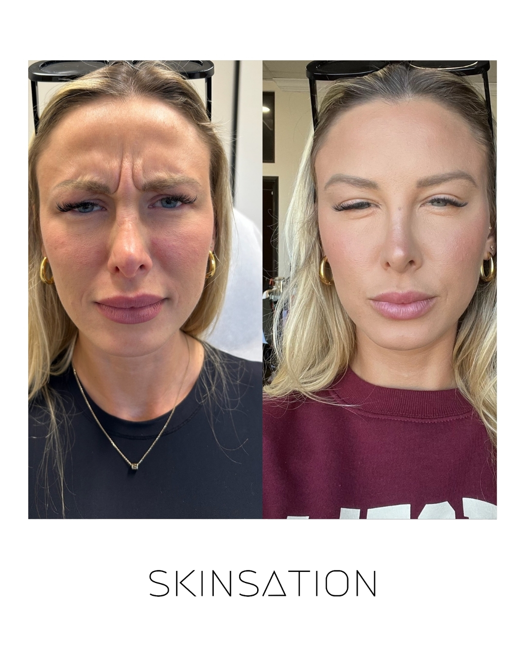 Injectable before and after result 12