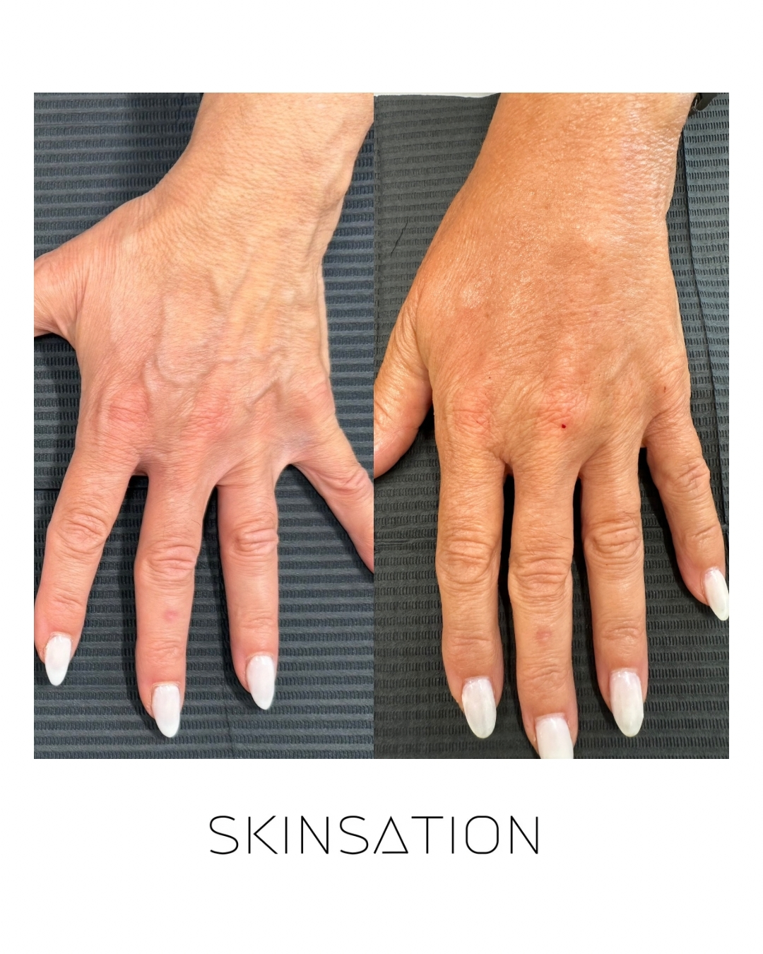 Injectable before and after result 13