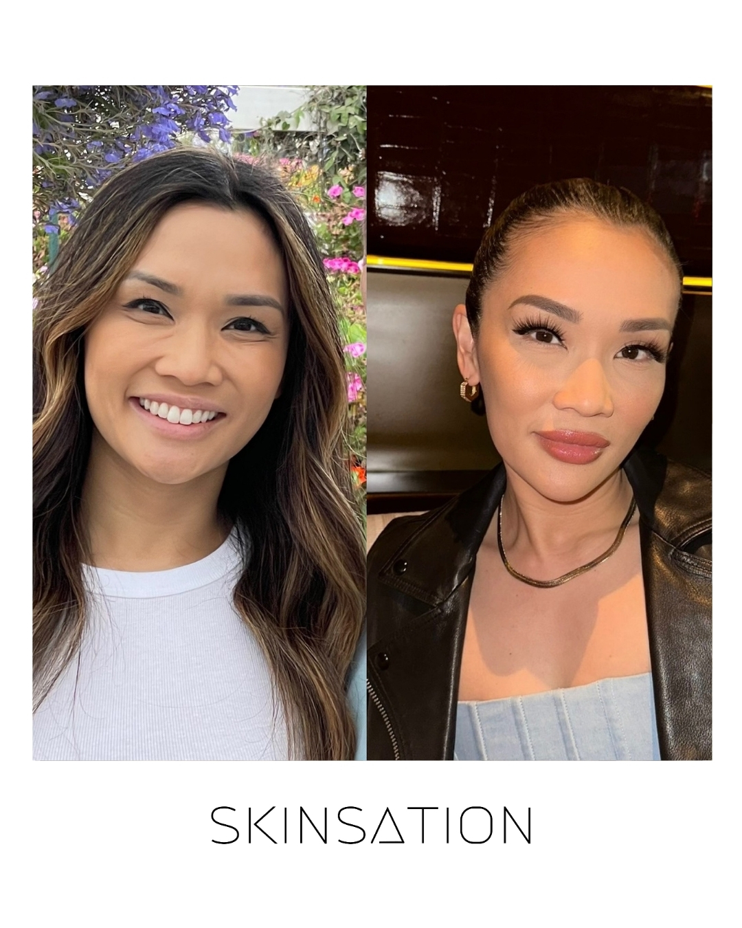 Injectable before and after result 14