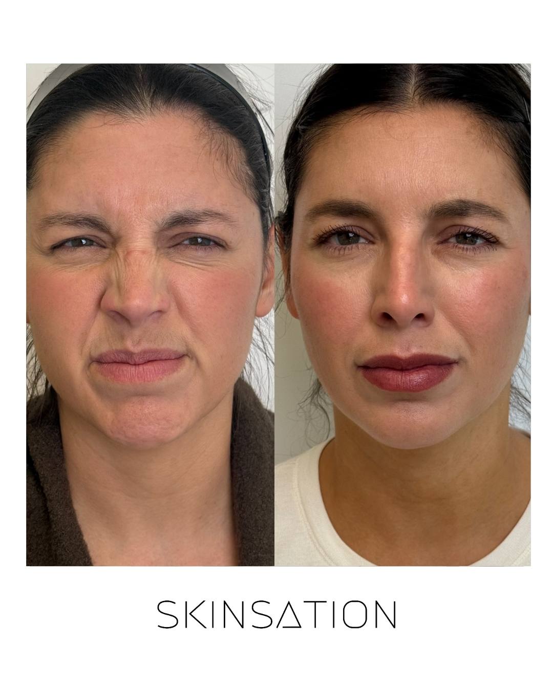 Injectable before and after result 15