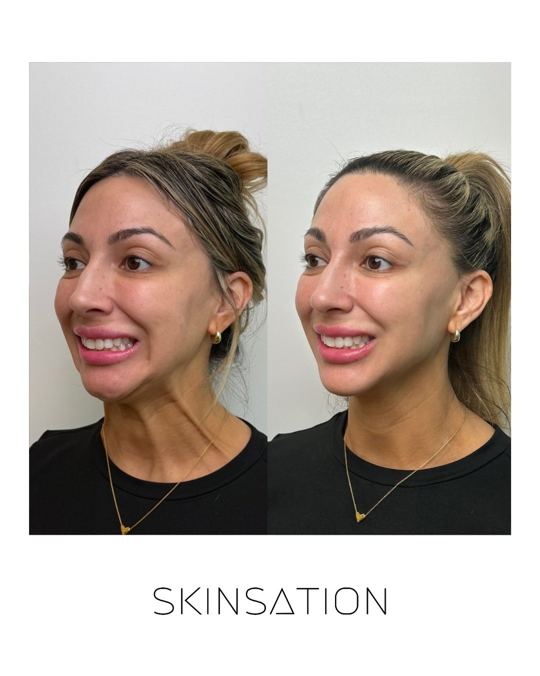 Injectable before and after result 16