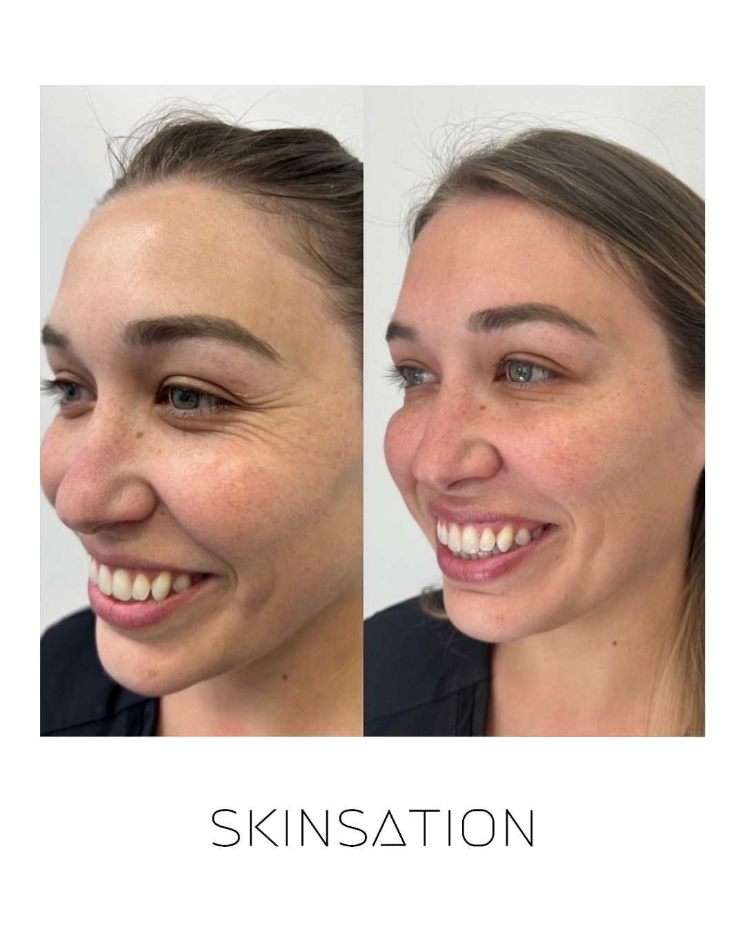Injectable before and after result 17
