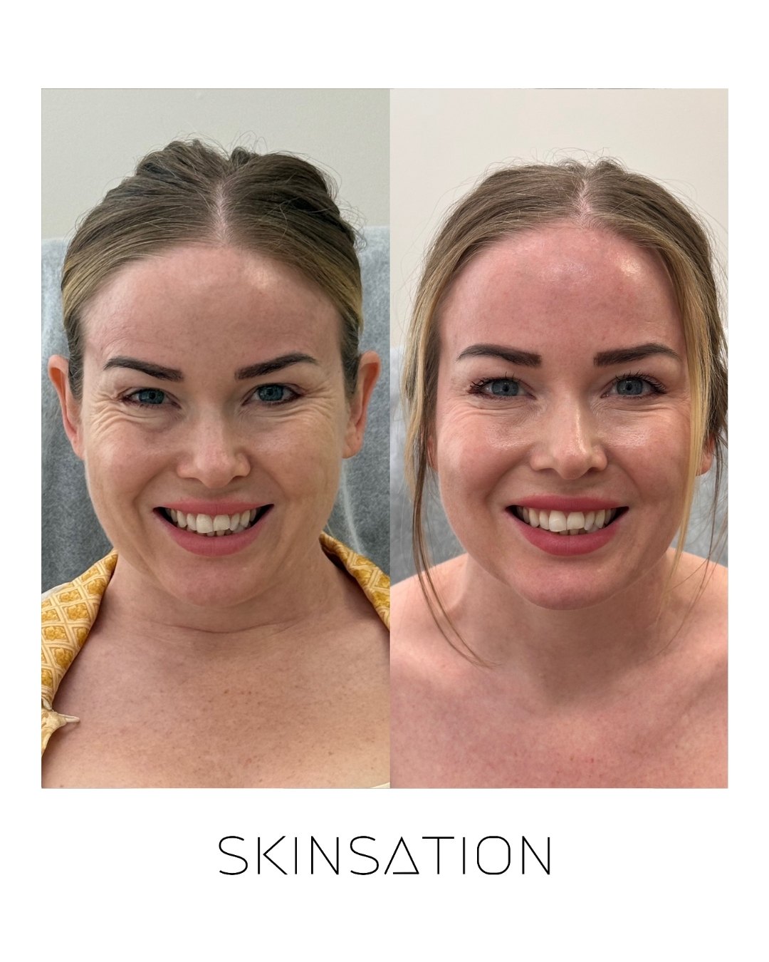 Injectable before and after result 18