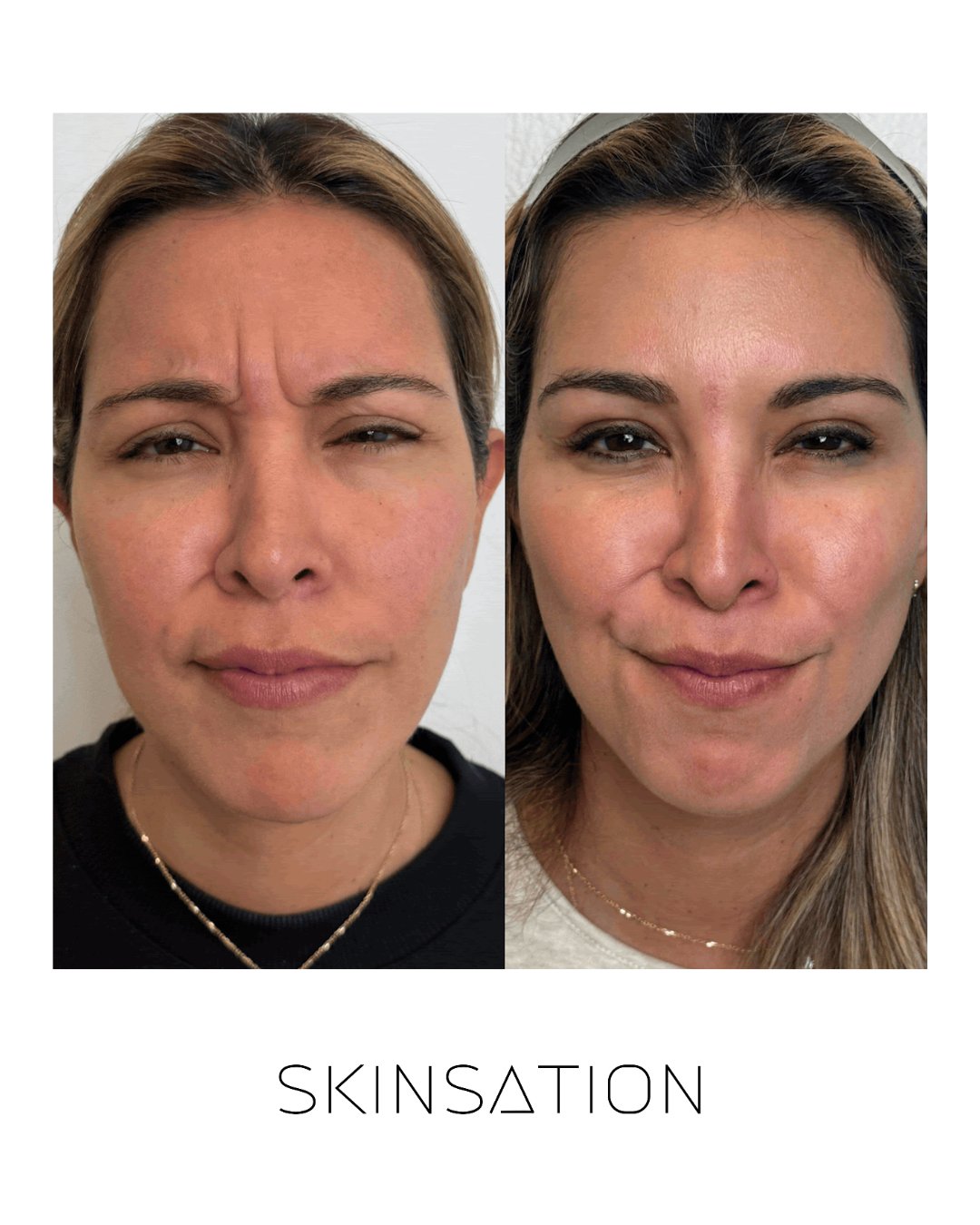 Injectable before and after result 19