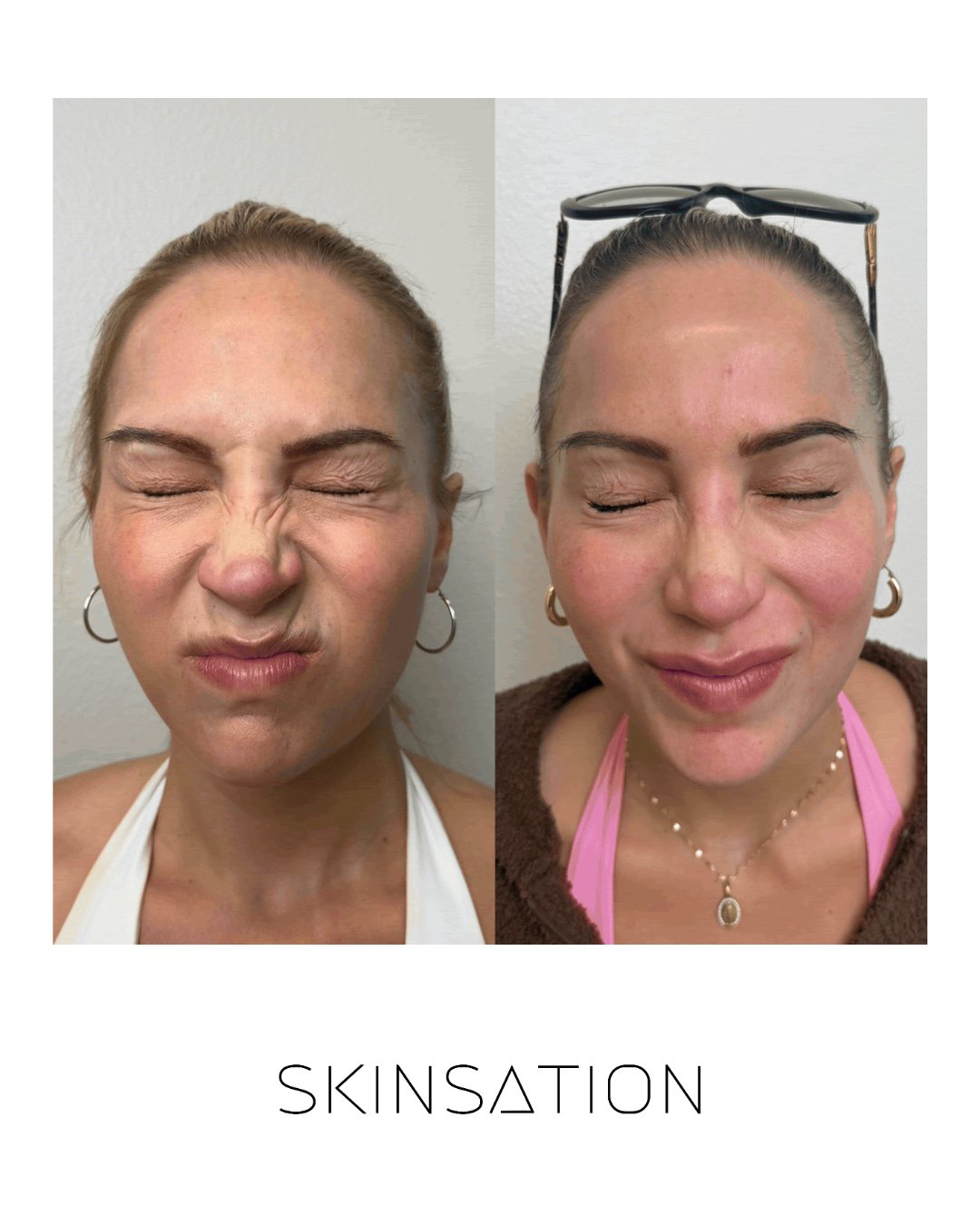 Injectable before and after result 20