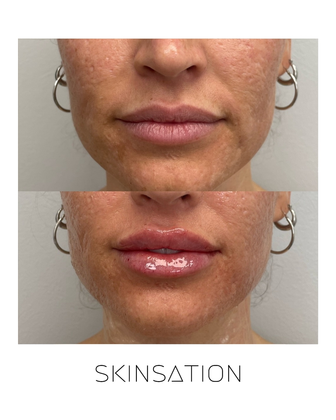 Injectable before and after result 21