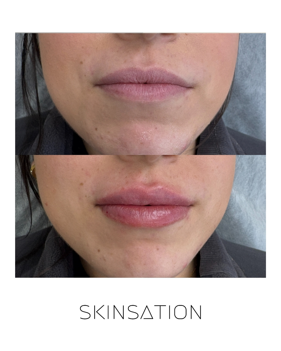 Injectable before and after result 22