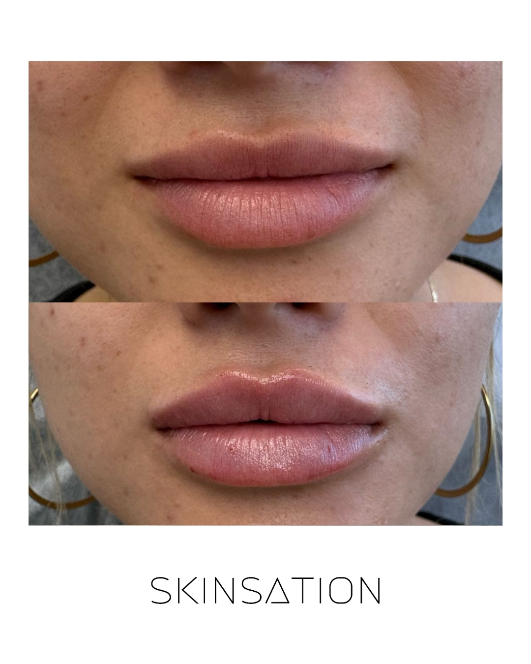 Injectable before and after result 23