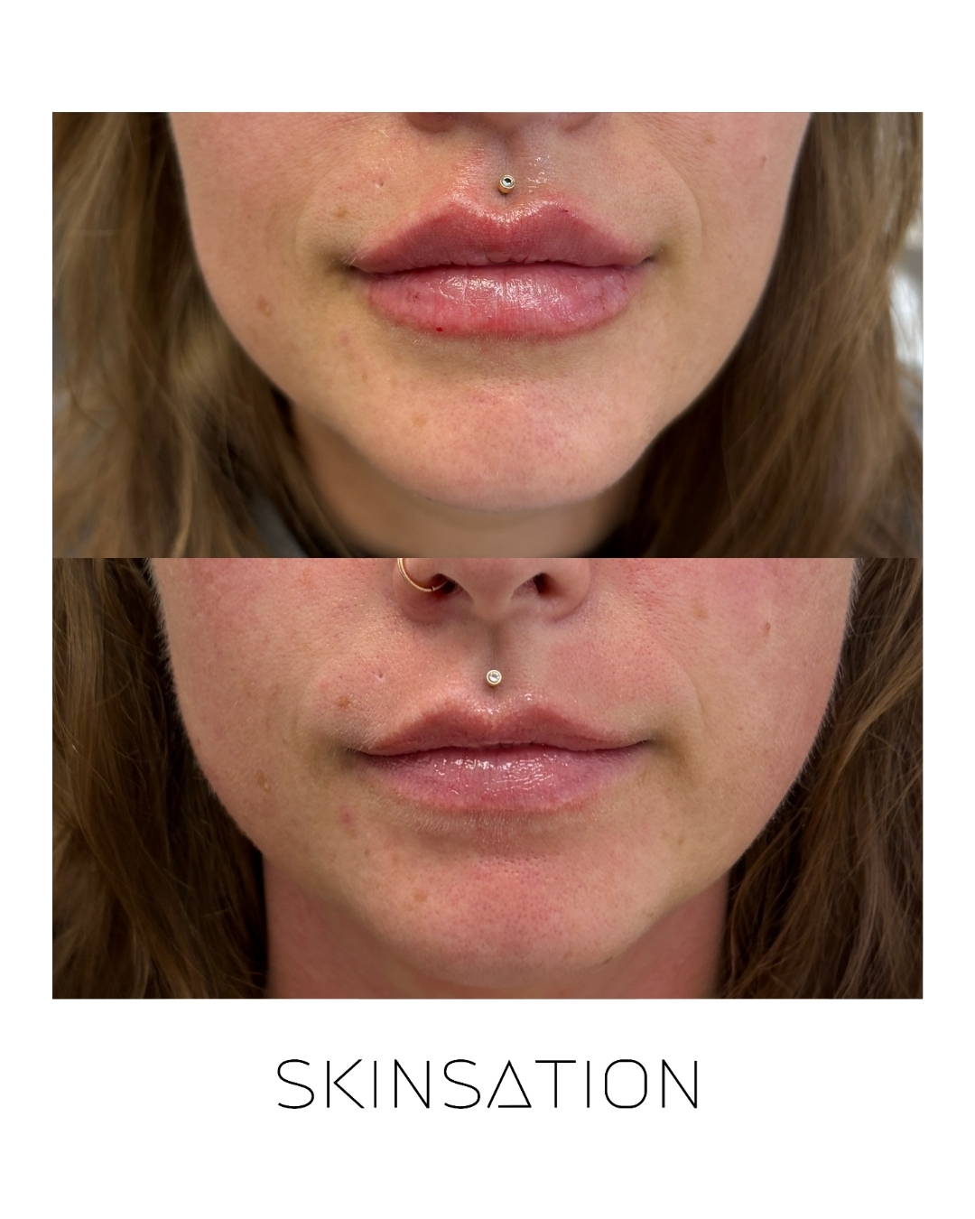 Injectable before and after result 24